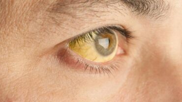 zespół gilberta objawia się zażółceniem oczu