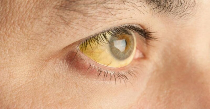 zespół gilberta objawia się zażółceniem oczu
